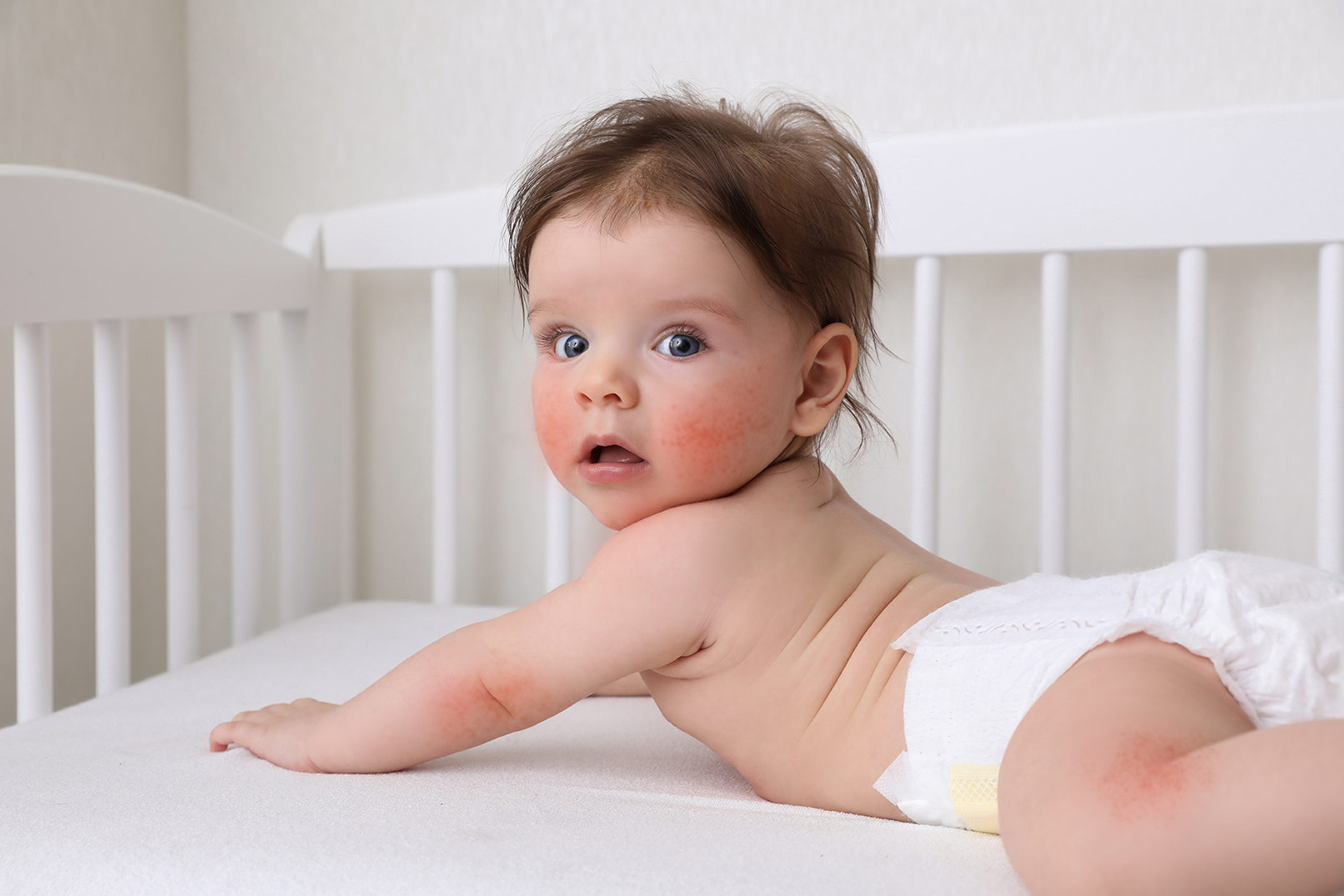 Allergy Baby